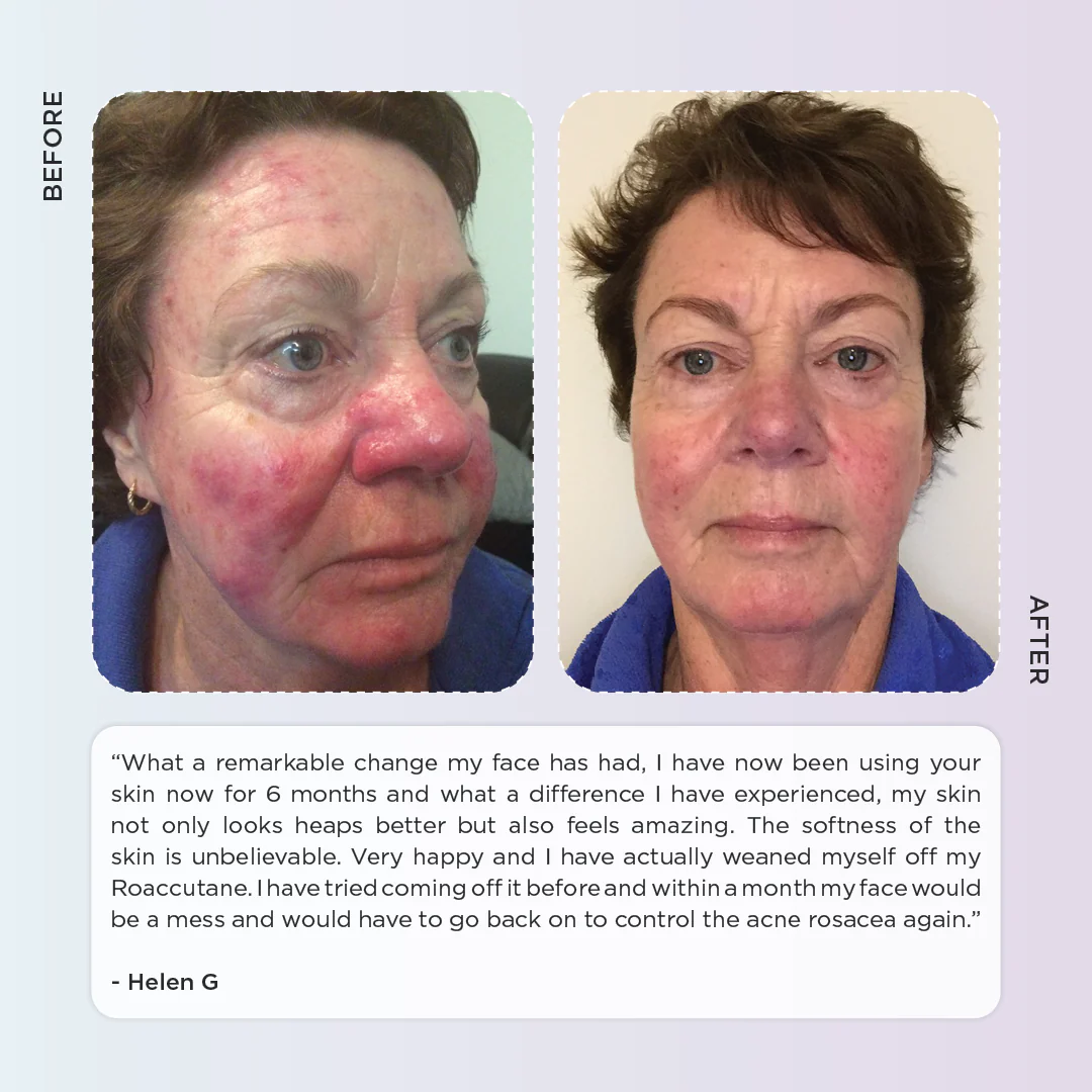 Rosacea Skincare Kit - Anti Redness - Image 4