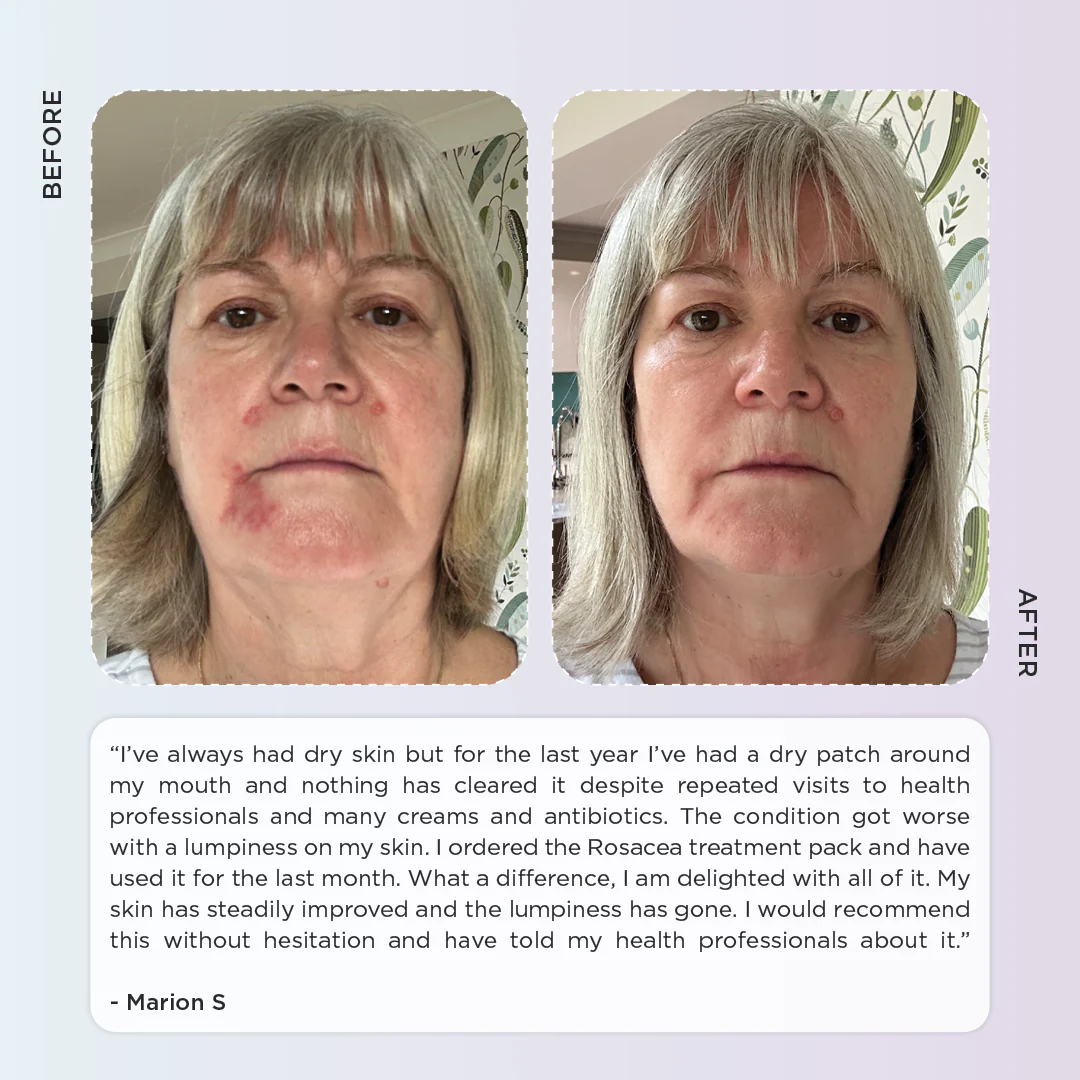 Rosacea Skincare Kit - Anti Redness - Image 5