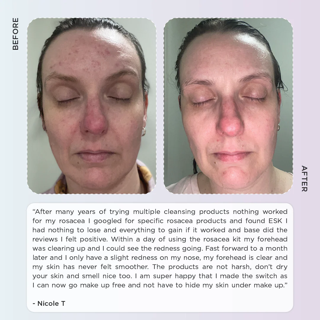 Rosacea Skincare Kit - Anti Redness - Image 6