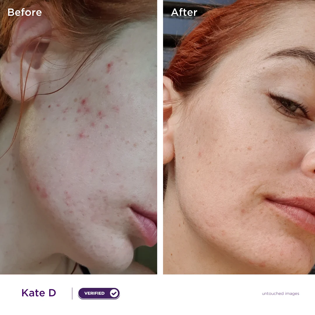 Acne Hero Kit - Image 7